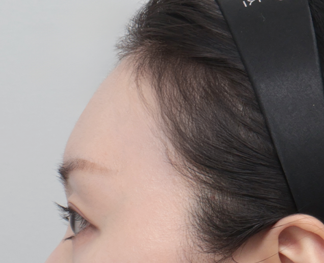 디자인 필러 전후 - 에이비 피부과