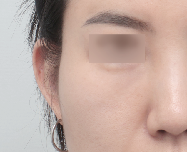 디자인 필러 전후 - 에이비 피부과