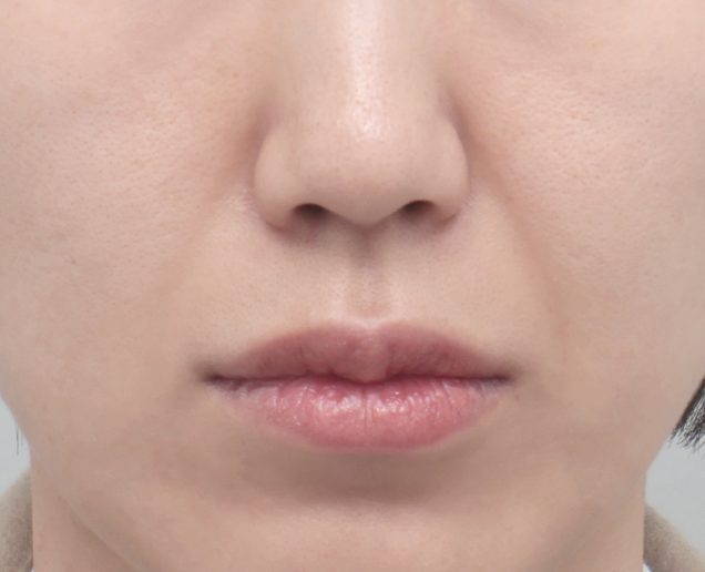 디자인 필러 전후 - 에이비 피부과