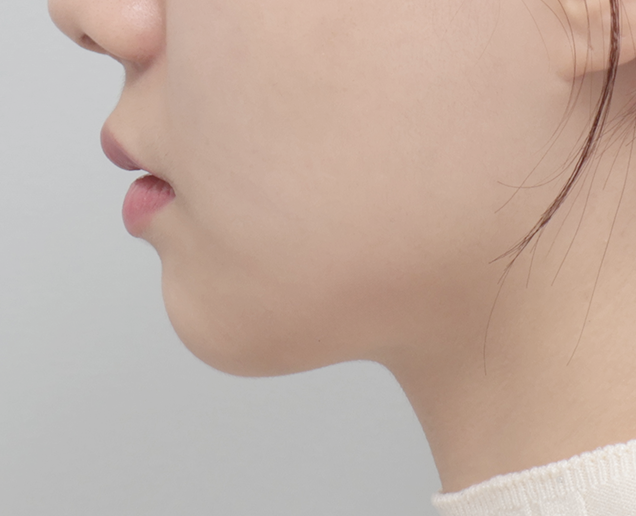 디자인 필러 전후 - 에이비 피부과