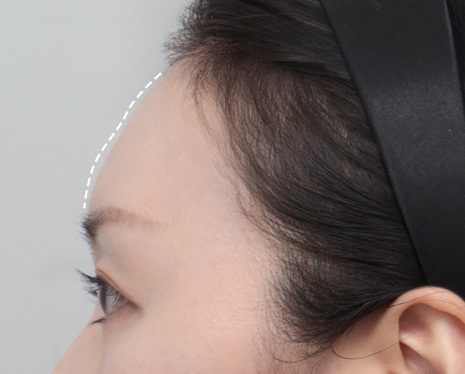 디자인 필러 전후 - 에이비 피부과