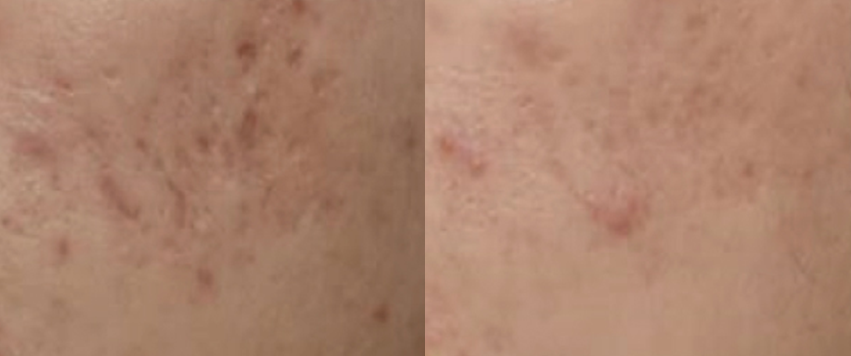 여드름 개선 전후사진