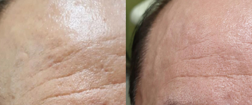 주름 개선 전후사진