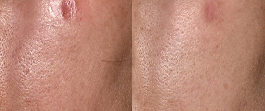 패인흉터 개선 전후사진