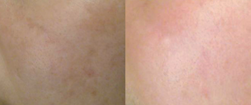 피부결 모공개선 전후사진