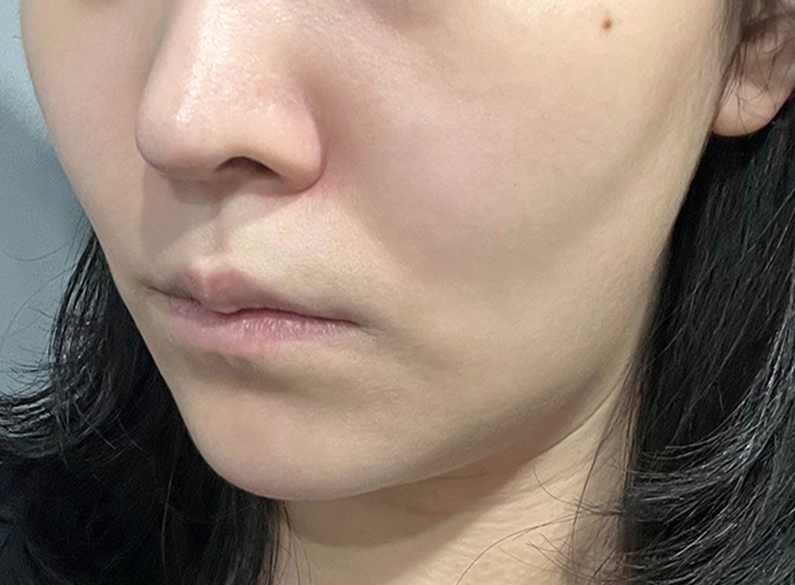 쥬베룩 전후 - 에이비 피부과