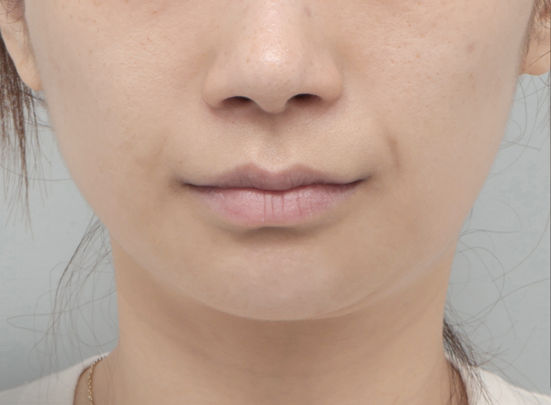 쥬베룩 전후 - 에이비 피부과