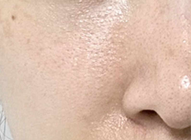 쥬베룩 전후 - 에이비 피부과