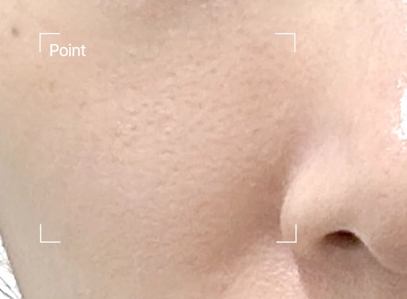 쥬베룩 전후 - 에이비 피부과