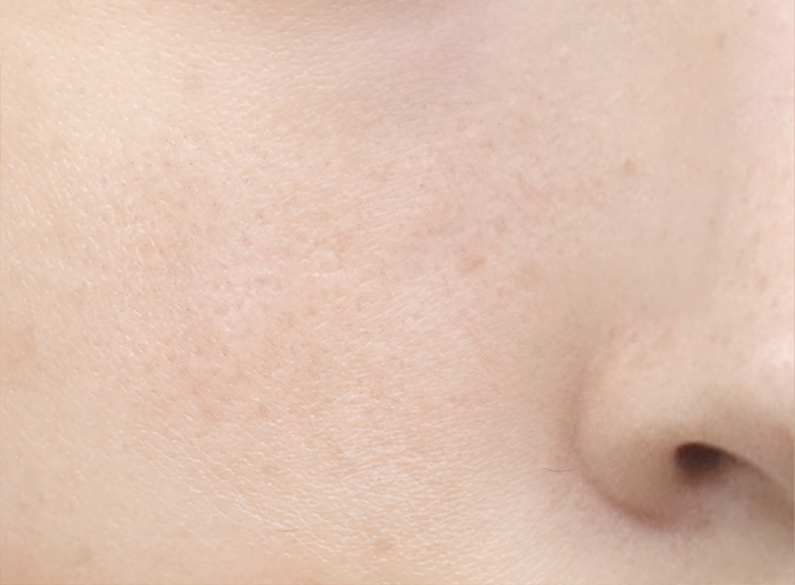 쥬베룩 전후 - 에이비 피부과