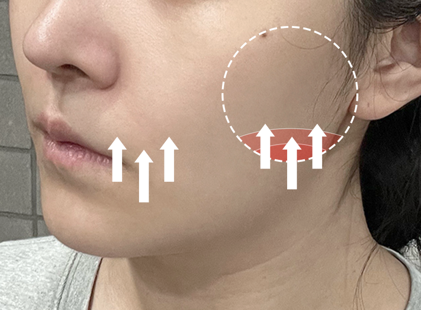 쥬베룩 시술 전후 - 에이비 피부과