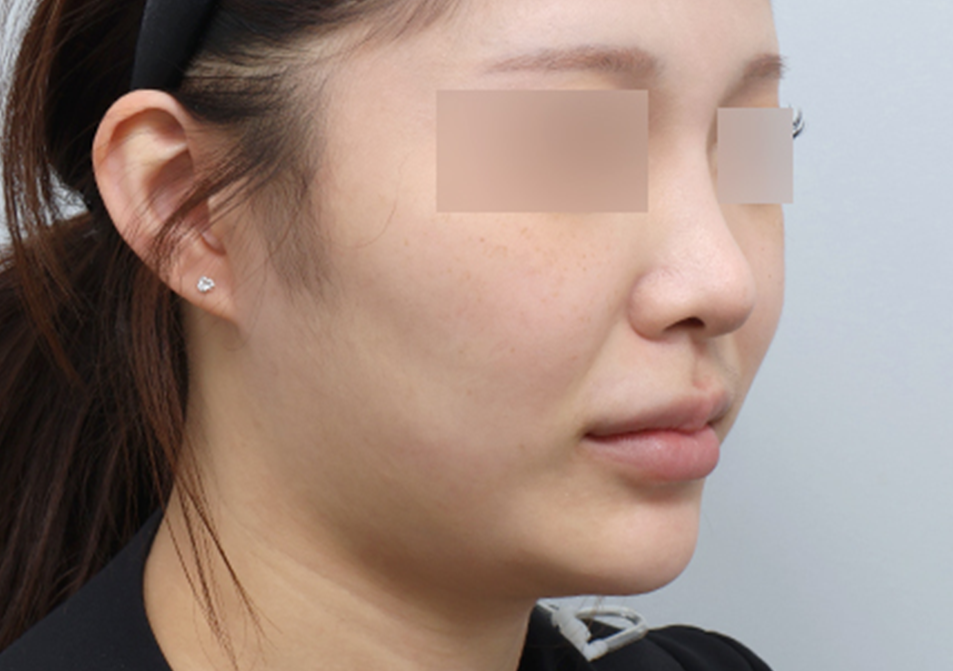 온다리프팅 페이스 전후사진 - 에이비 피부과