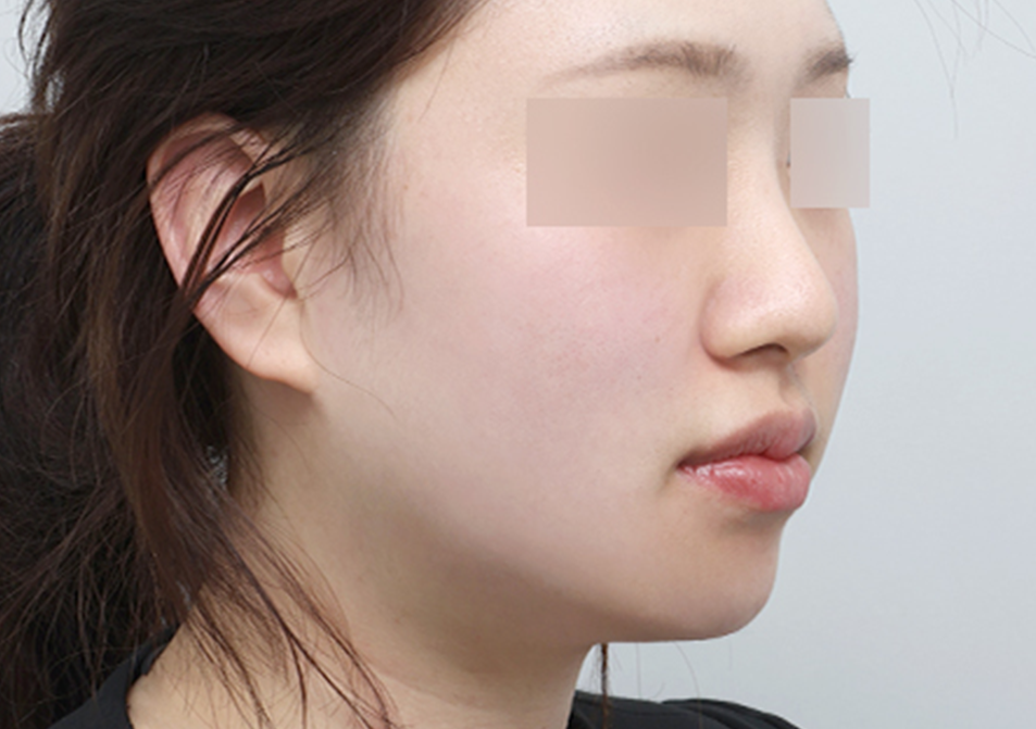 온다리프팅 페이스 전후사진 - 에이비 피부과