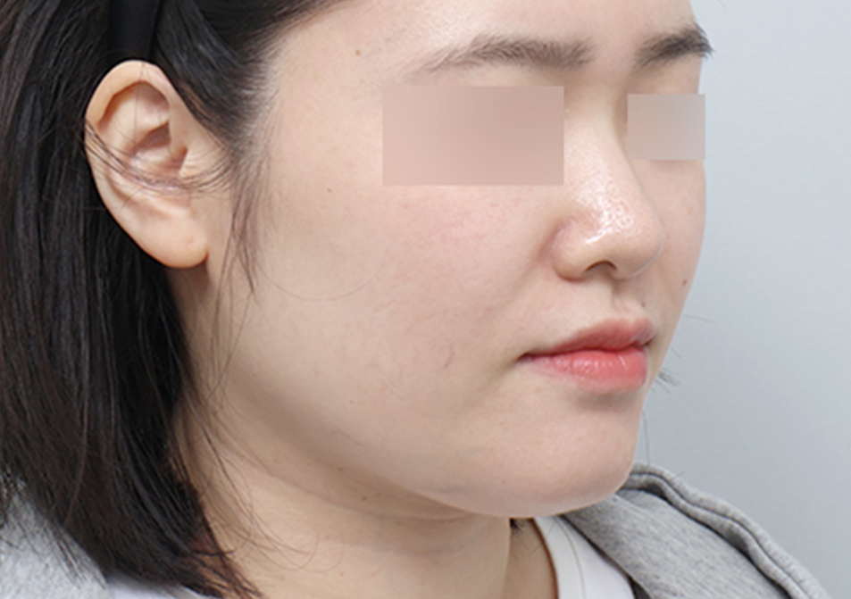 온다리프팅 페이스 전후사진 - 에이비 피부과
