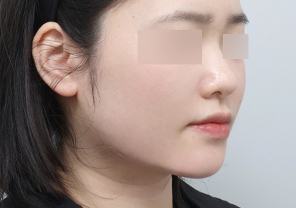 온다리프팅 페이스 전후사진 - 에이비 피부과