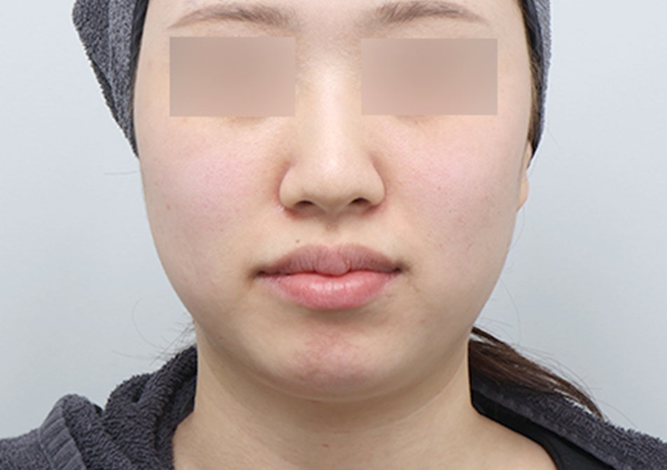 온다리프팅 페이스 전후사진 - 에이비 피부과