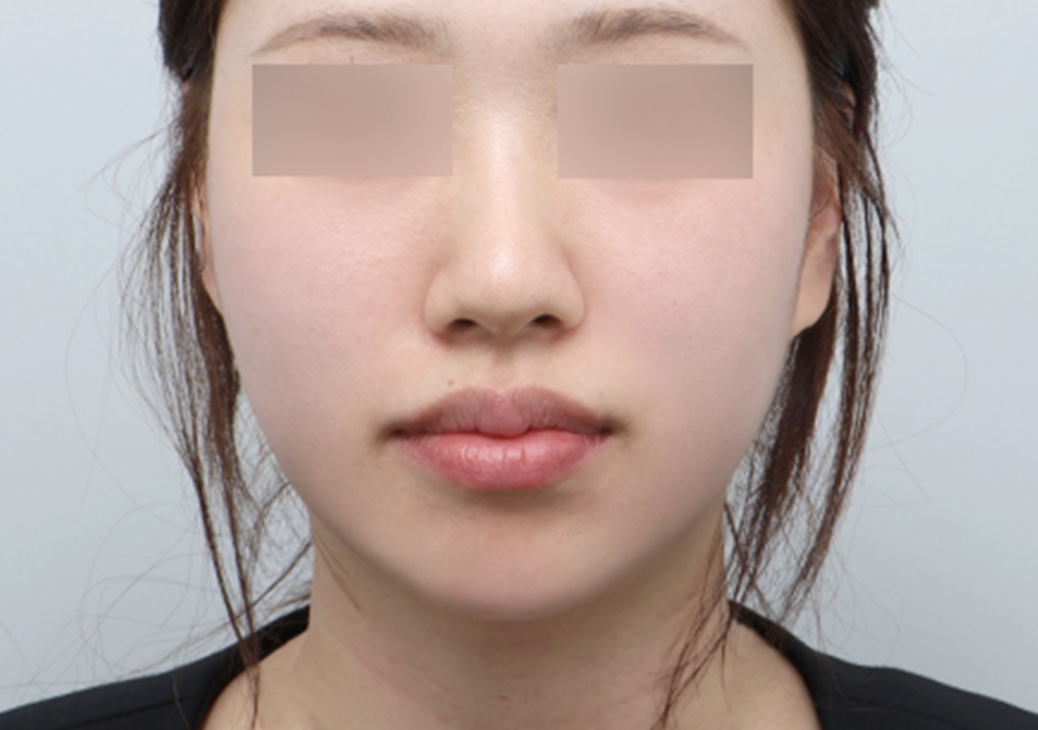 온다리프팅 페이스 전후사진 - 에이비 피부과