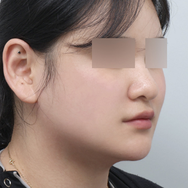 쏙프팅 전후