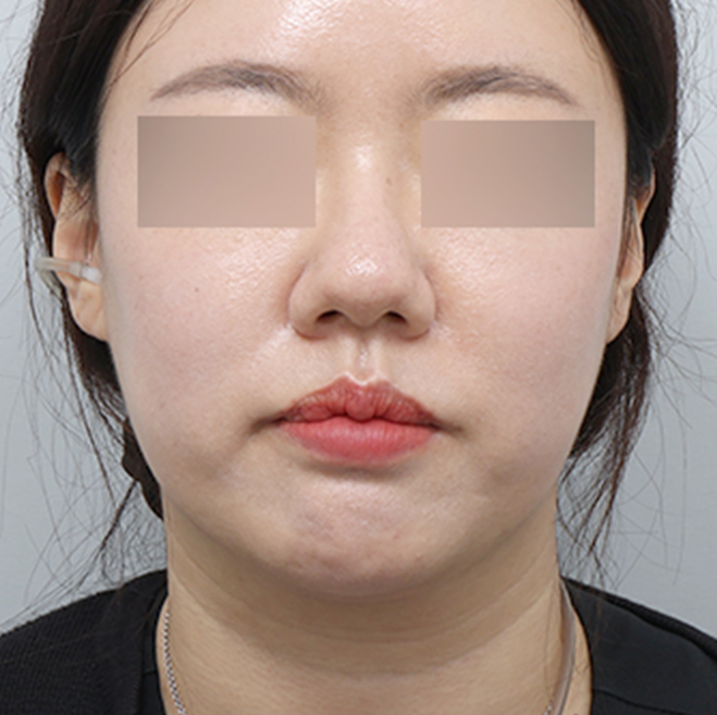 쏙프팅 전후