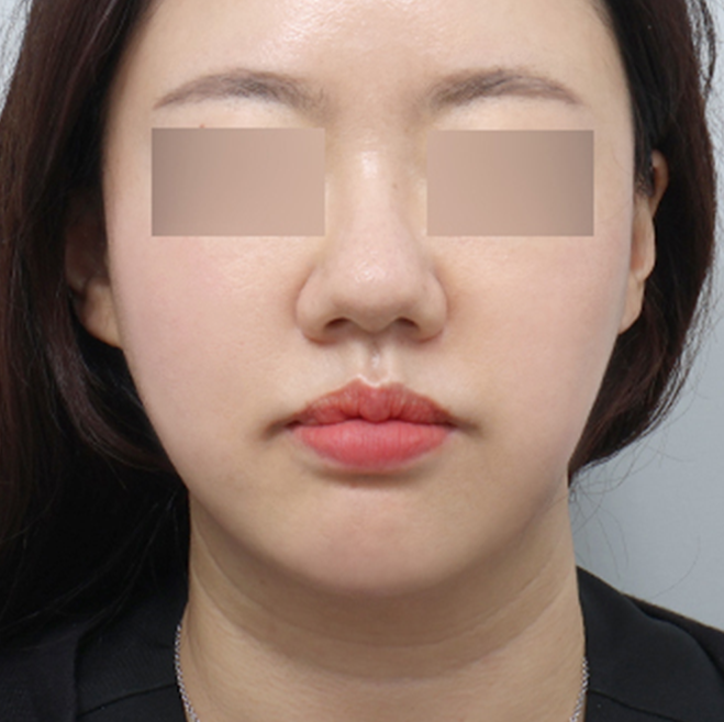 쏙프팅 전후