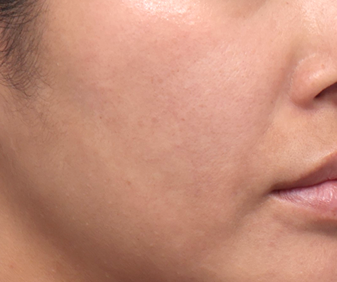 콜라겐 맥스 써마지 - 시술 전후