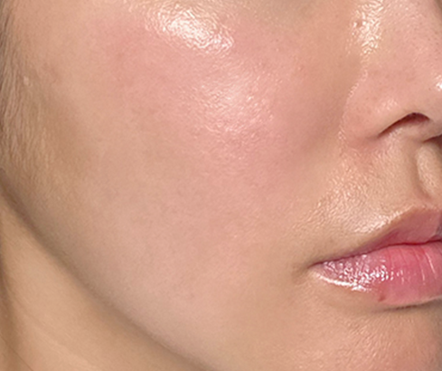 콜라겐 맥스 써마지 - 시술 전후