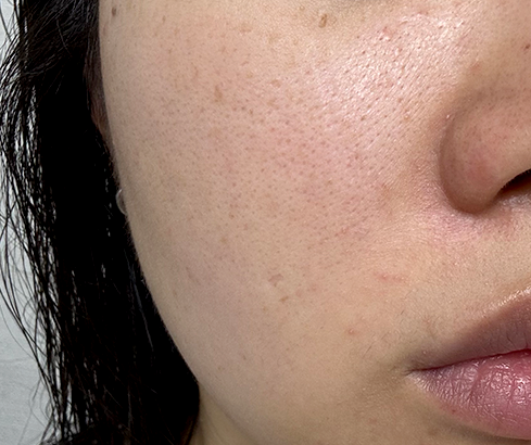 콜라겐 맥스 써마지 - 시술 전후