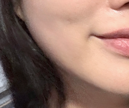 콜라겐 맥스 써마지 - 시술 전후