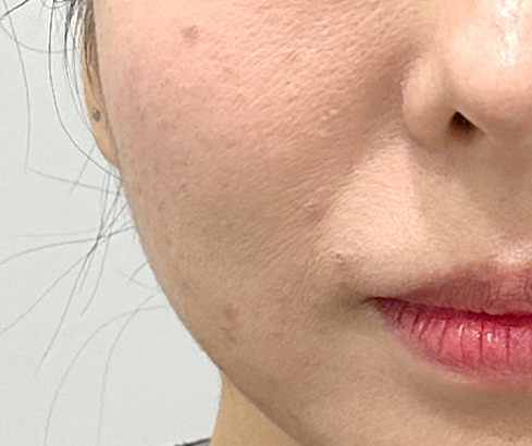 콜라겐 맥스 써마지 - 시술 전후