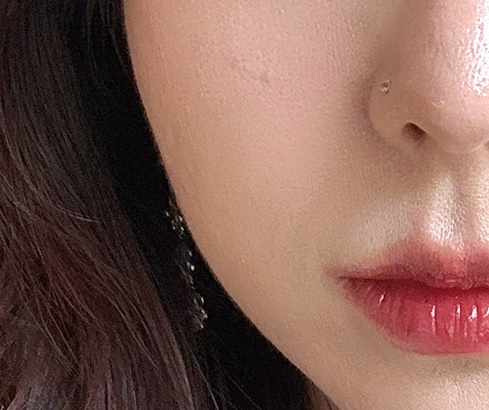 콜라겐 맥스 써마지 - 시술 전후