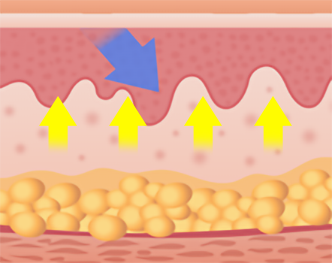 일반 써마지 콜라겐 MAX 써마지 비교