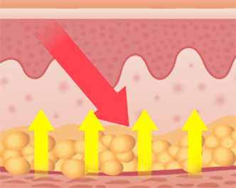 일반 써마지 콜라겐 MAX 써마지 비교