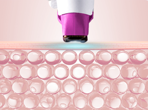 아큐렙 맞춤 에너지 조절 기술