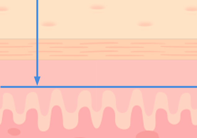 에이비 커스텀 실리프팅 기술력 - 에이비 피부과