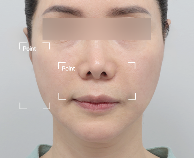 실리프팅 전후 - 에이비 피부과