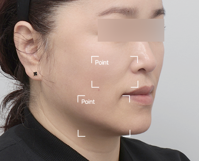 실리프팅 전후 - 에이비 피부과