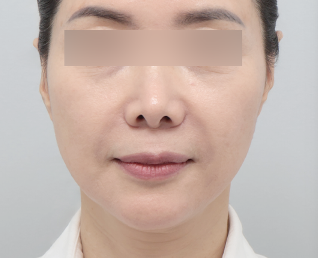 실리프팅 전후 - 에이비 피부과