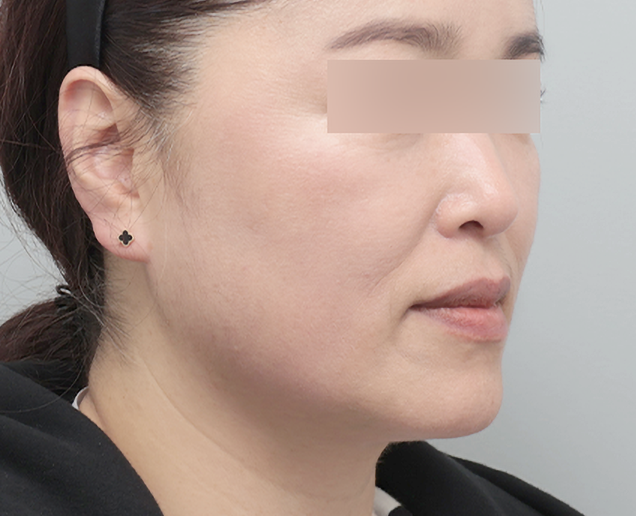 실리프팅 전후 - 에이비 피부과