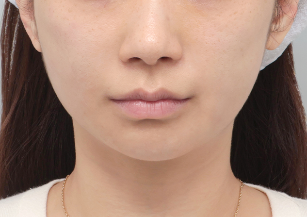 울쎄라피 프라임 전후