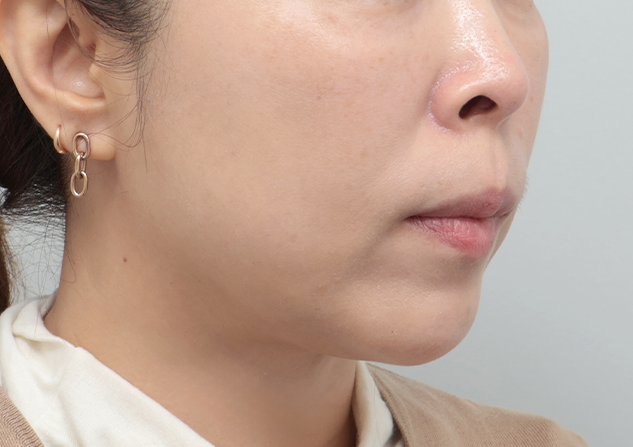 울쎄라피 프라임 전후