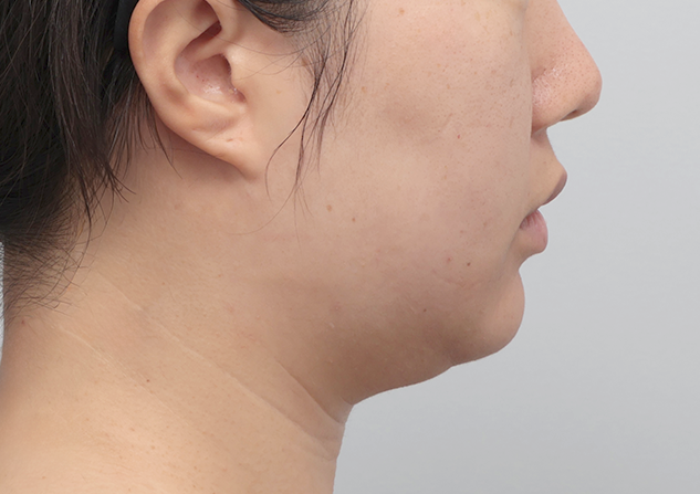 울쎄라피 프라임 전후