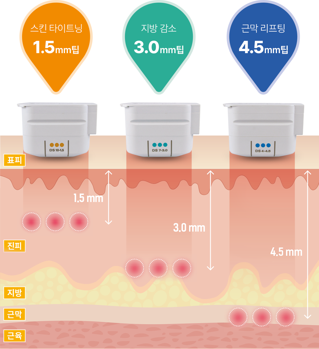 트랜스듀서로 맞춤 시술