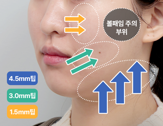 울쎄라피 프라임 시술 전후