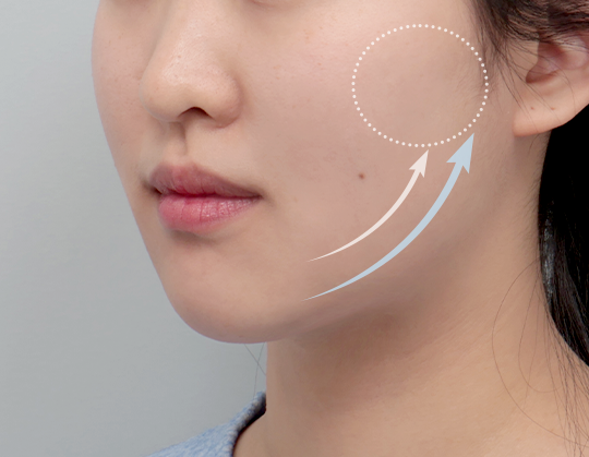 울쎄라피 프라임 시술 전후