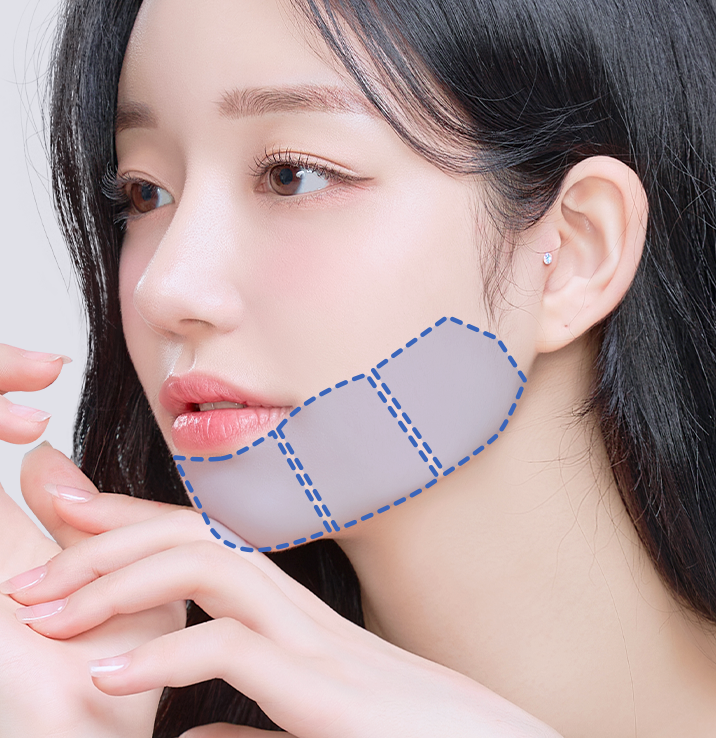 4.5mm팁 - 에이비 피부과