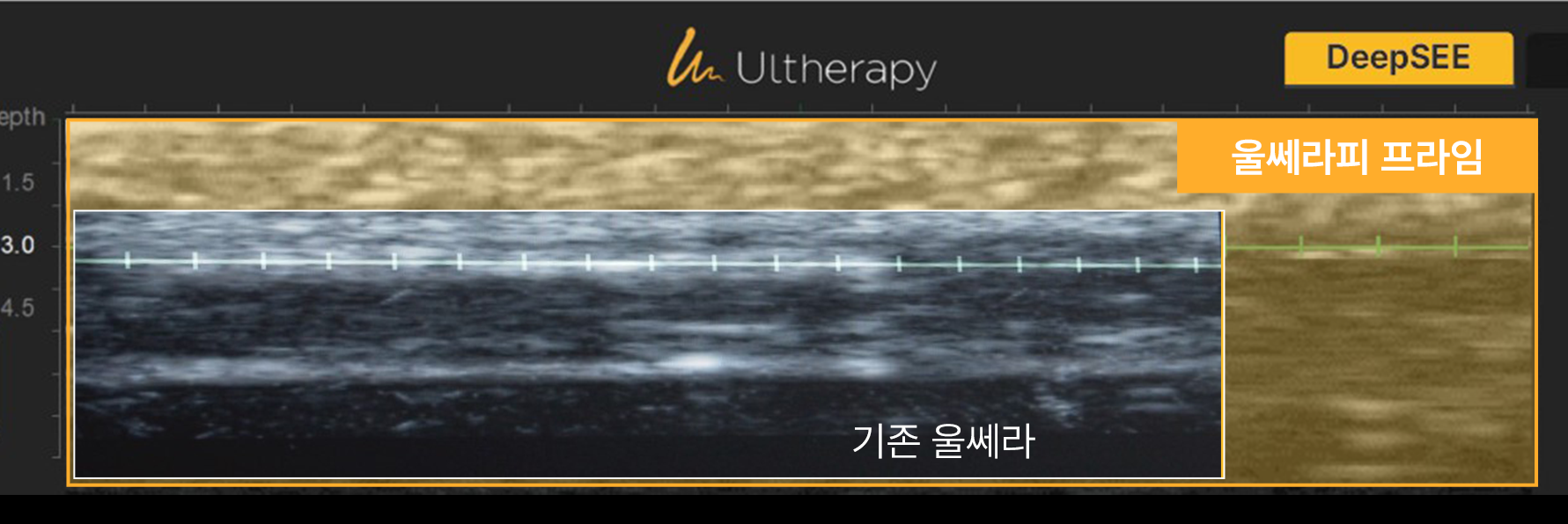 초음파 화면 - 에이비 피부과