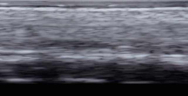 울쎄라피 프라임 초음파 화면 필터 - 에이비 피부과