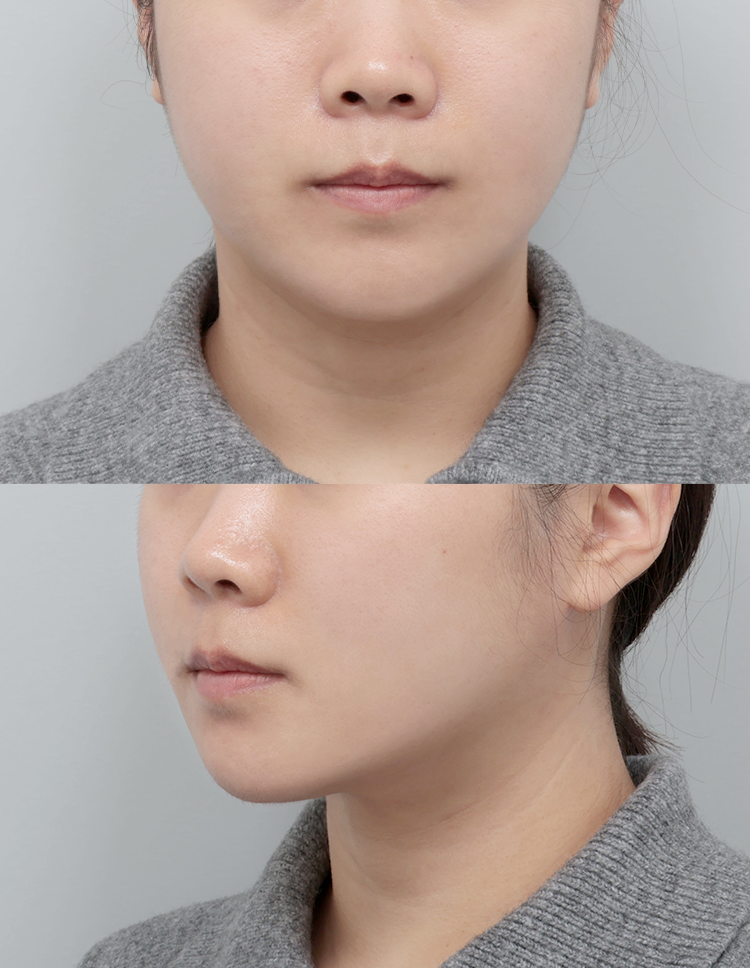 울쎄라 전후 - 에이비 피부과