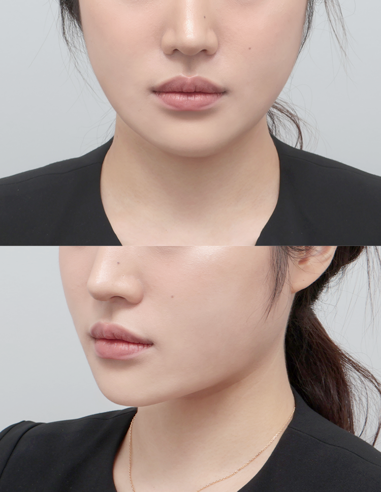 울쎄라 전후 - 에이비 피부과