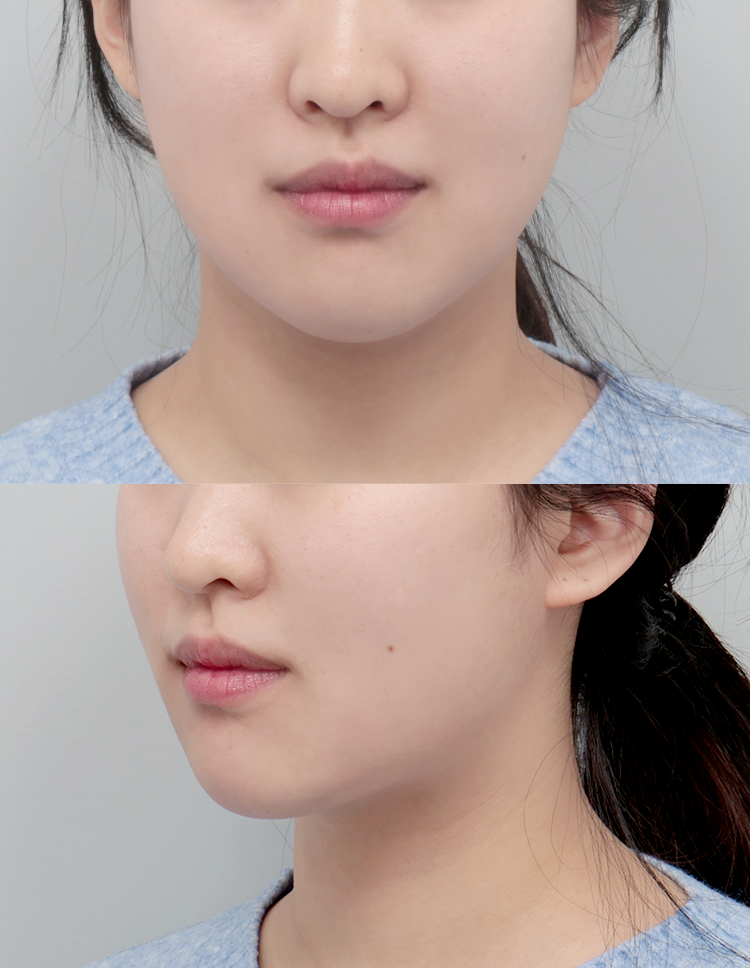 울쎄라 전후 - 에이비 피부과